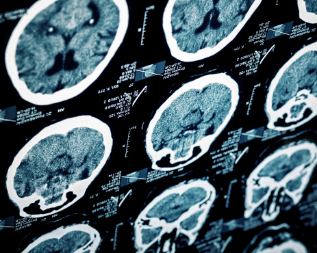 Traumatic Brain Injury FAQ