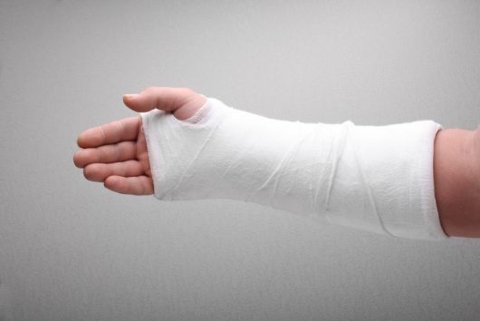 Are You Suffering from an Impacted Fracture? You May Be Eligible for Compensation 