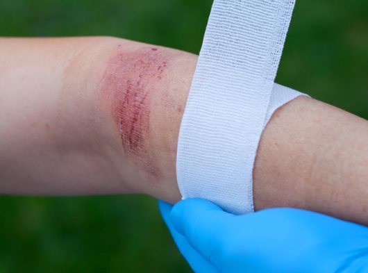 The Effects of Burn Injuries Aren’t Just Physical: Pain, Suffering, and Emotional Distress After a Burn 