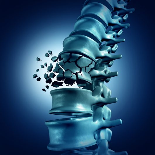 Your Options After a Spinal Cord Injury: Should You Work with the Insurance Company?