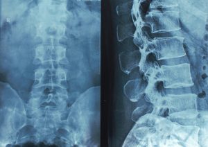 Spinal Cord Injuries Can Be Caused by a Number of Factors