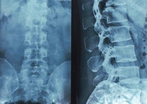 The Basics of Spinal Cord Injuries Caused by California Car Accidents