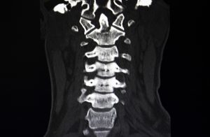 Understanding Lumbar Spinal Cord Injuries and How They Can Affect Your Life