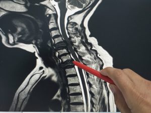 Common Outcomes of Traumatic Brain Injuries and Spinal Cord Injuries